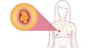 breast-cancer-caused-by-too-much-belly-fat